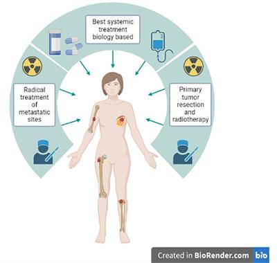 Locoregional treatment of de novo stage IV breast cancer in the era of modern oncology
